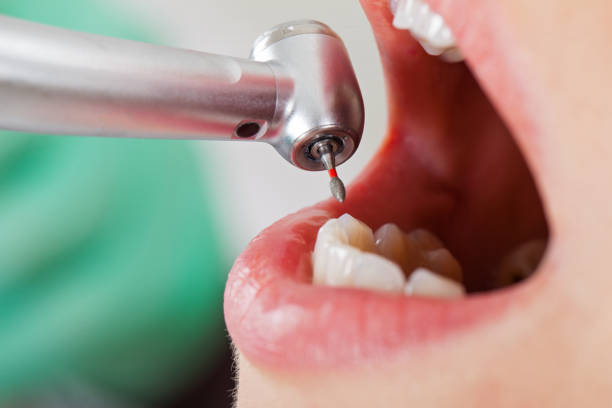 Best Emergency Root Canal Treatment in Decorah, IA